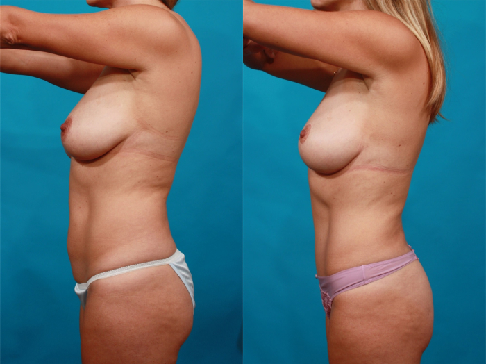 Гукас Миракян подтяжка груди до и после