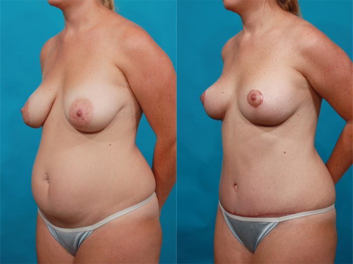 Гукас Миракян подтяжка груди до и после