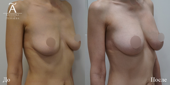 Пациентка пластического хирурга Арслана Пенаева до и после липофилинга груди.