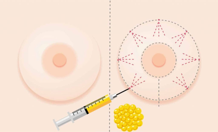 Липофилинг груди: насколько долгосрочны результаты операции?