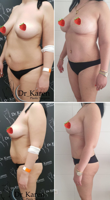 Пациентка пластического хирурга Карена Пайтяна после операции ПостНатал