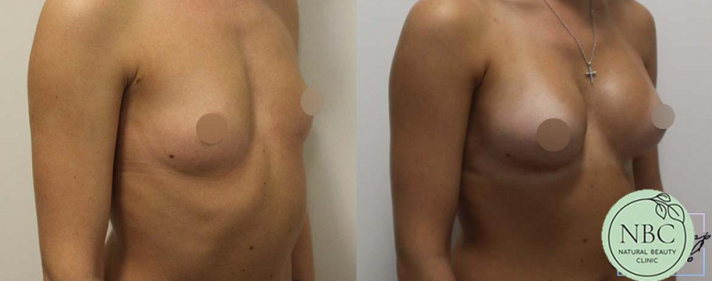 Пациентка пластического хирурга Арслана Пенаева. Фото до и после увеличения груди имплантами