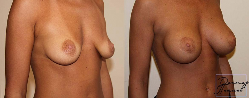 Пациентка пластического хирурга Арслана Пенаева. Фото до и после увеличения груди имплантами в Москве