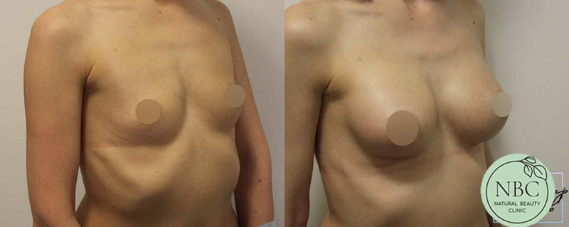 Пациентка пластического хирурга Арслана Пенаева. Фотографии до и после увеличения груди имплантами