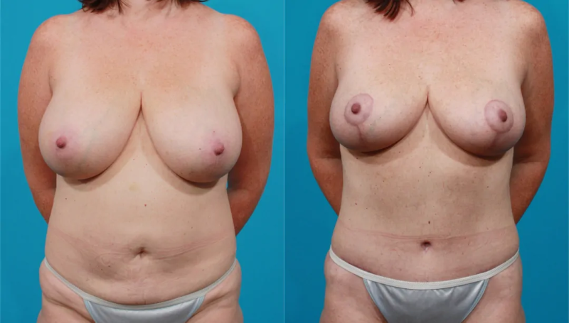 Пациентка пластического хирурга Гукаса Миракяна до и после операции по уменьшению размера груди