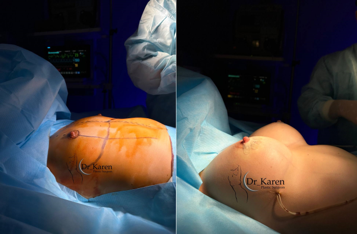 Пациентка доктора Карена до и после увеличения груди имплантами. Фото на операционном столе