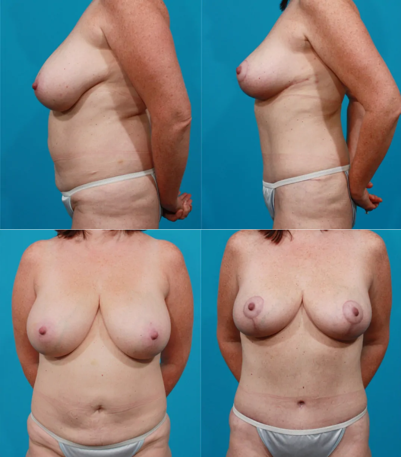 Пациентка доктора Гукаса Миракяна до и после операции по уменьшению груди