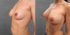 Пациентка доктора Дмитрия Крысина до и после увеличения груди имплантатами