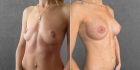 Пациентка доктора Дмитрия Крысина до и после увеличения груди имплантами