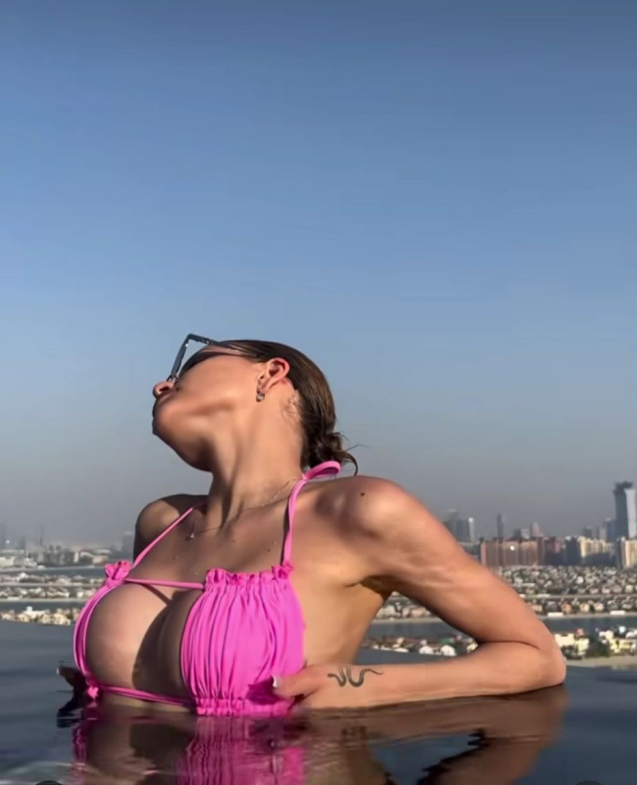 Пациентка после увеличения груди. Оперировал доктор Гукас Миракян