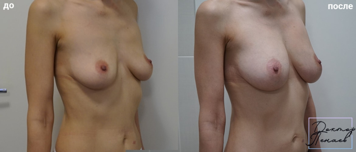 Пациентка пластического хирурга Арслана Пенаева до и после липофилинга груди