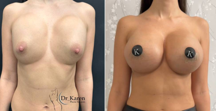 Реэндопротезирование груди (замена имплантов)