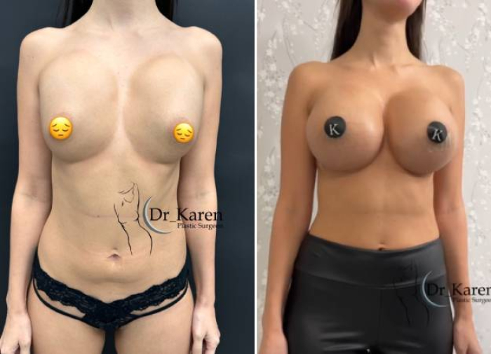 Замена имплантов Карен Пайтян