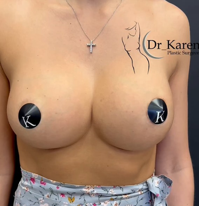 Пациентка Карена Пайтяна через 1 год после операции. Установлены импланты 450 мл