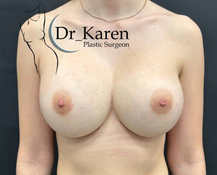 Пациентка Карена Пайтяна через 1 год после операции. Установлены импланты 600 мл