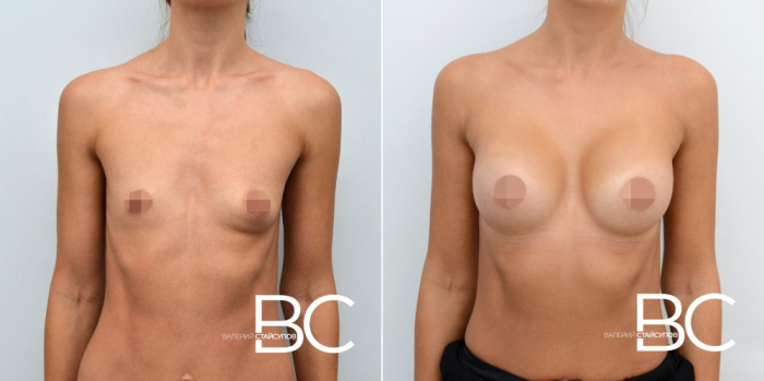 Пациентка доктора В.Ю. Стайсупова до и после пластики груди