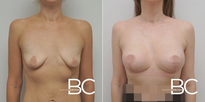 Пациентка доктора В.Ю. Стайсупова до и после пластики груди