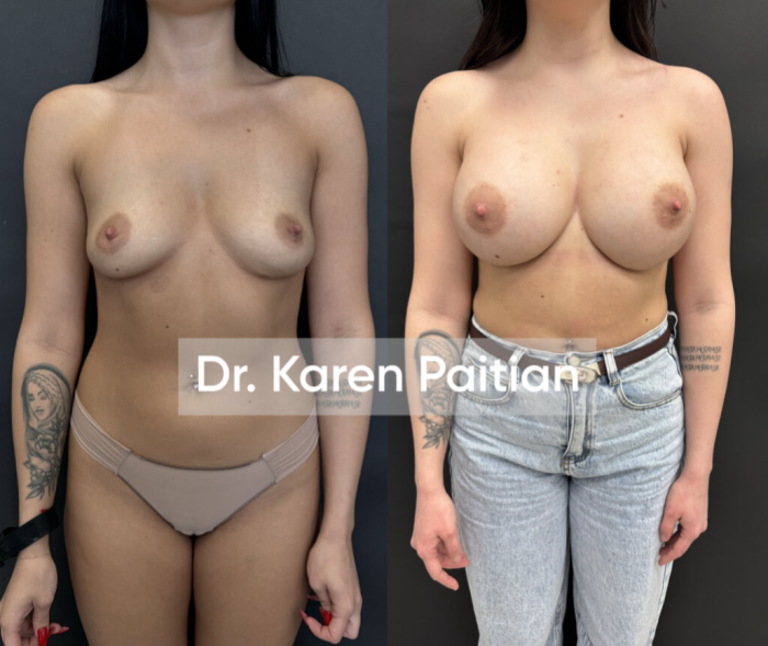 К.Г. Пайтян. Пациентка до и после увеличения груди